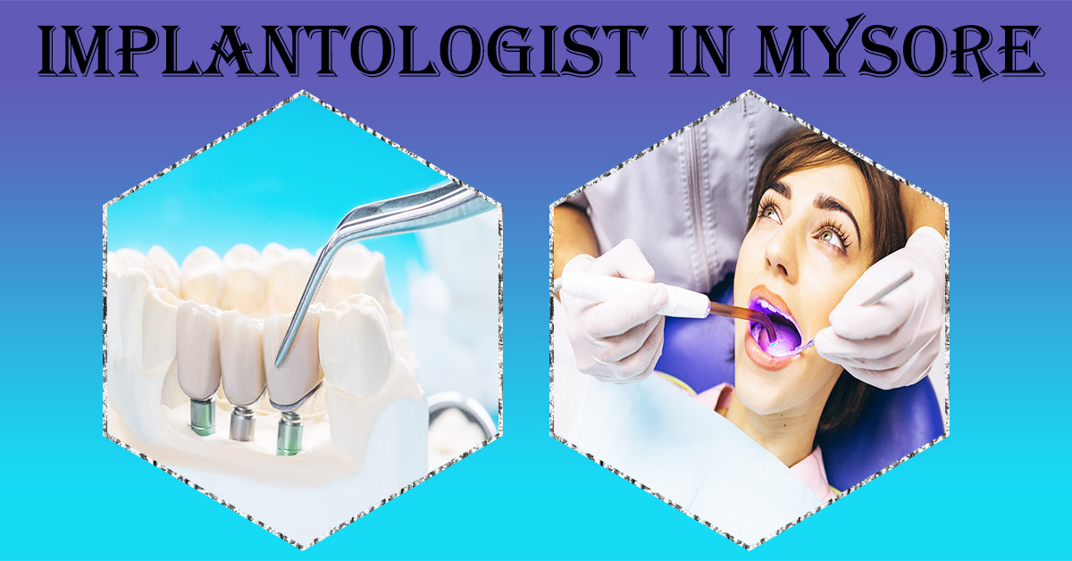 Implantologist in Mysore