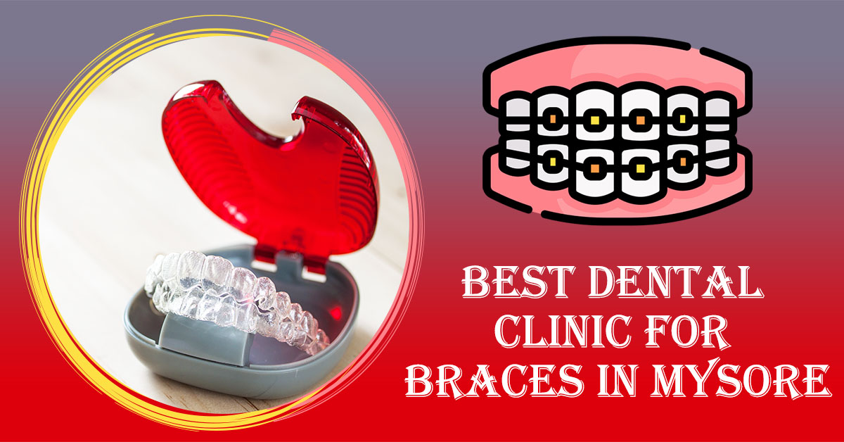 Best-Dental-Clinic-for-Braces-in-Mysore