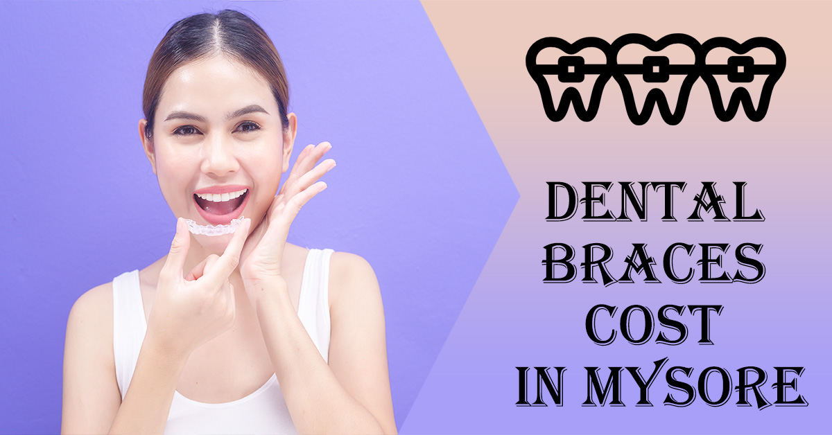 Dental-Braces-Cost-in-Mysore
