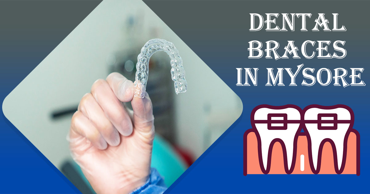 Dental-Braces-in-Mysore