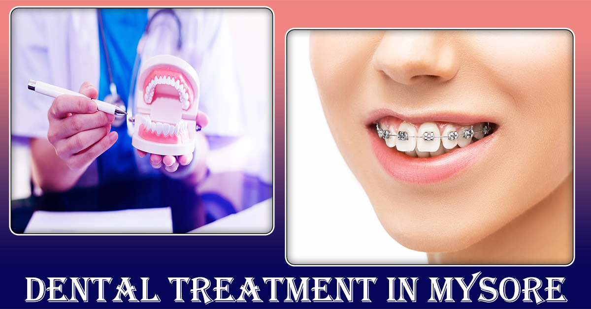 Dental-Treatment-in-Mysore